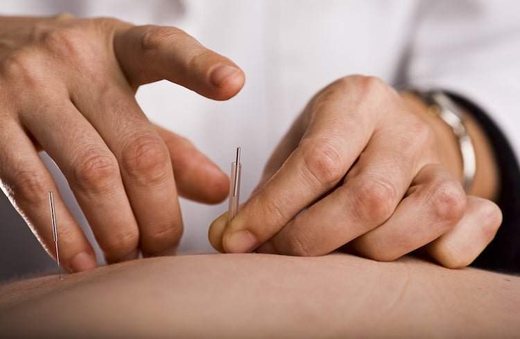 Can Acupuncture Improve Fertility? - Conceive Plus® UK